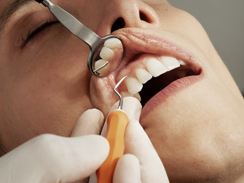 Dental Fillings (Tooth Decay Treatment)