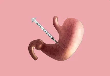Sleeve Gastrectomy